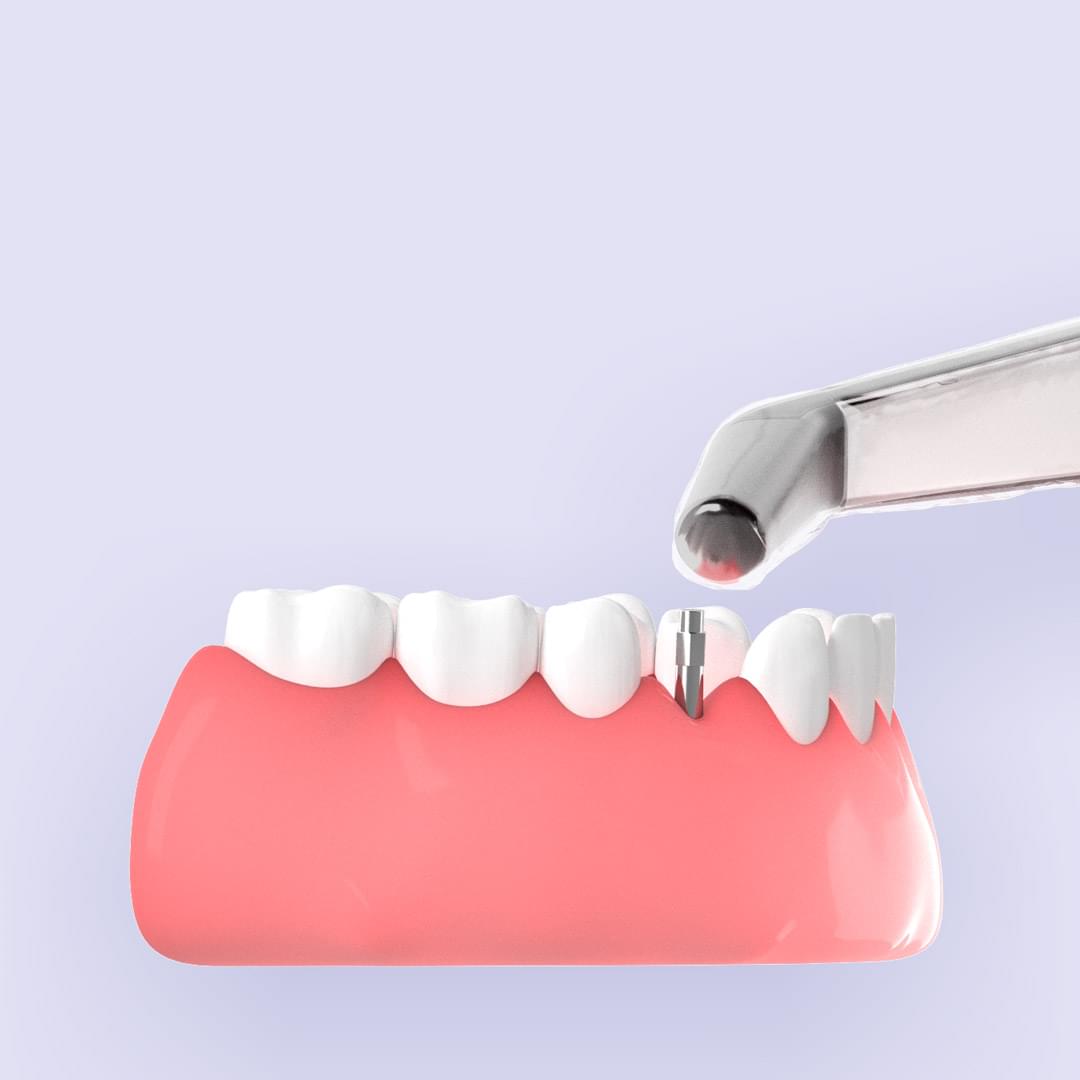 Visualisering av tänder där en tand är ersatt med ett implantat där Ostells instrument mäter stabilitet i implantatet.